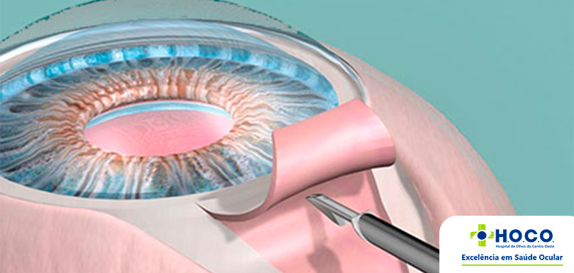 Cirurgia de Glaucoma