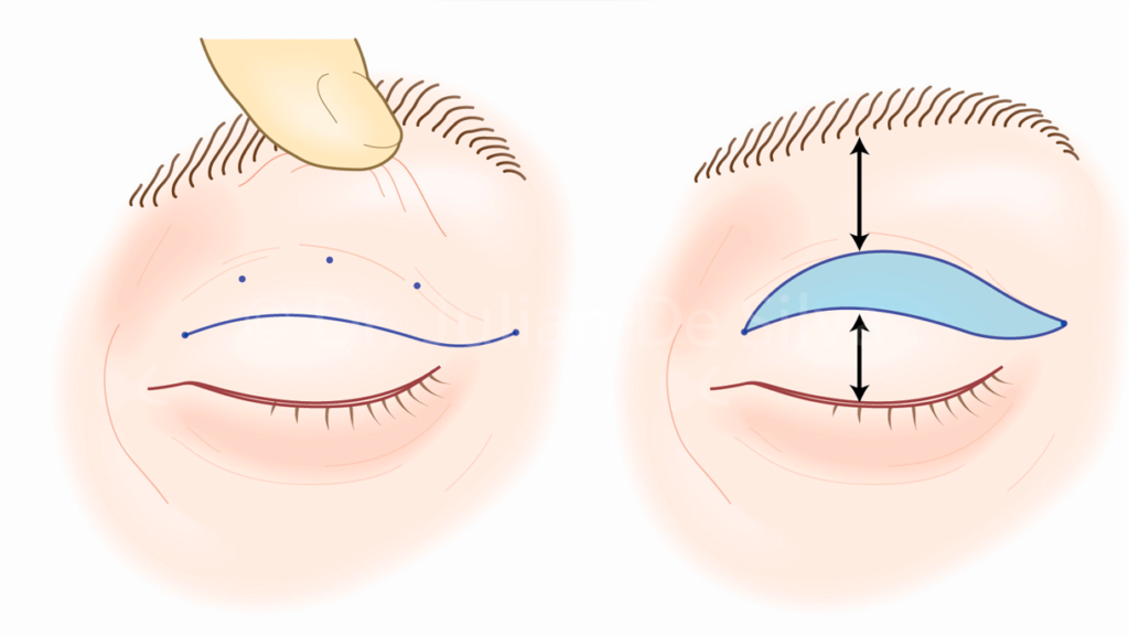 Pálpebras caídas? Transforme seu olhar e rejuvenesça seu rosto