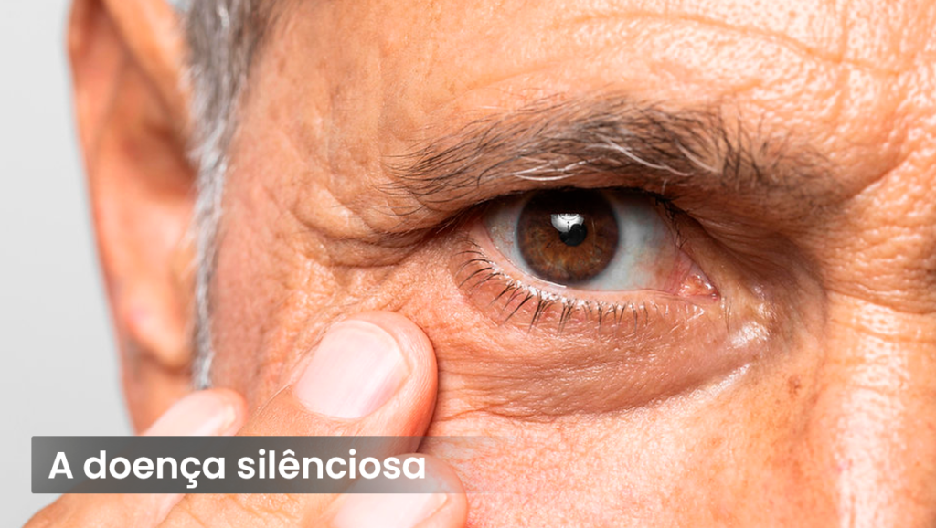 Glaucoma: A doença silenciosa que pode roubar sua visão 