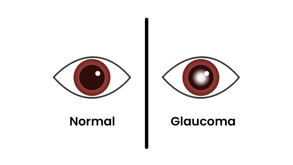 Glaucoma: A doença silenciosa que pode roubar sua visão 